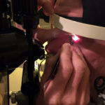 Don O'Neill sits perfectly still while the doctor pulls stitches from his left eye. (Josh Kerns, KIRO Radio)