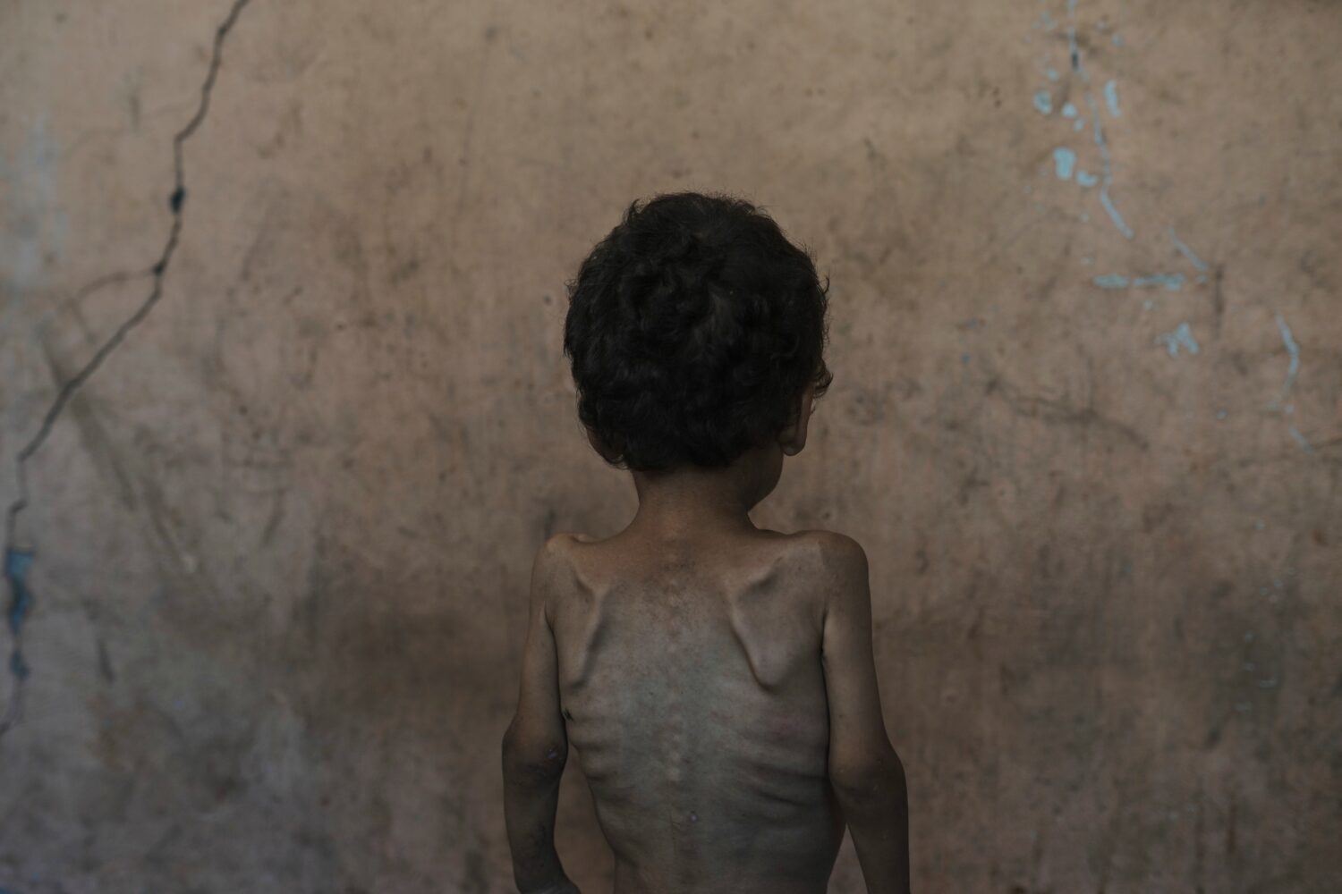 FILE.- Yazan Abu Ful, a 2-year-old malnourished child, poses for a photo at his family home in the ...