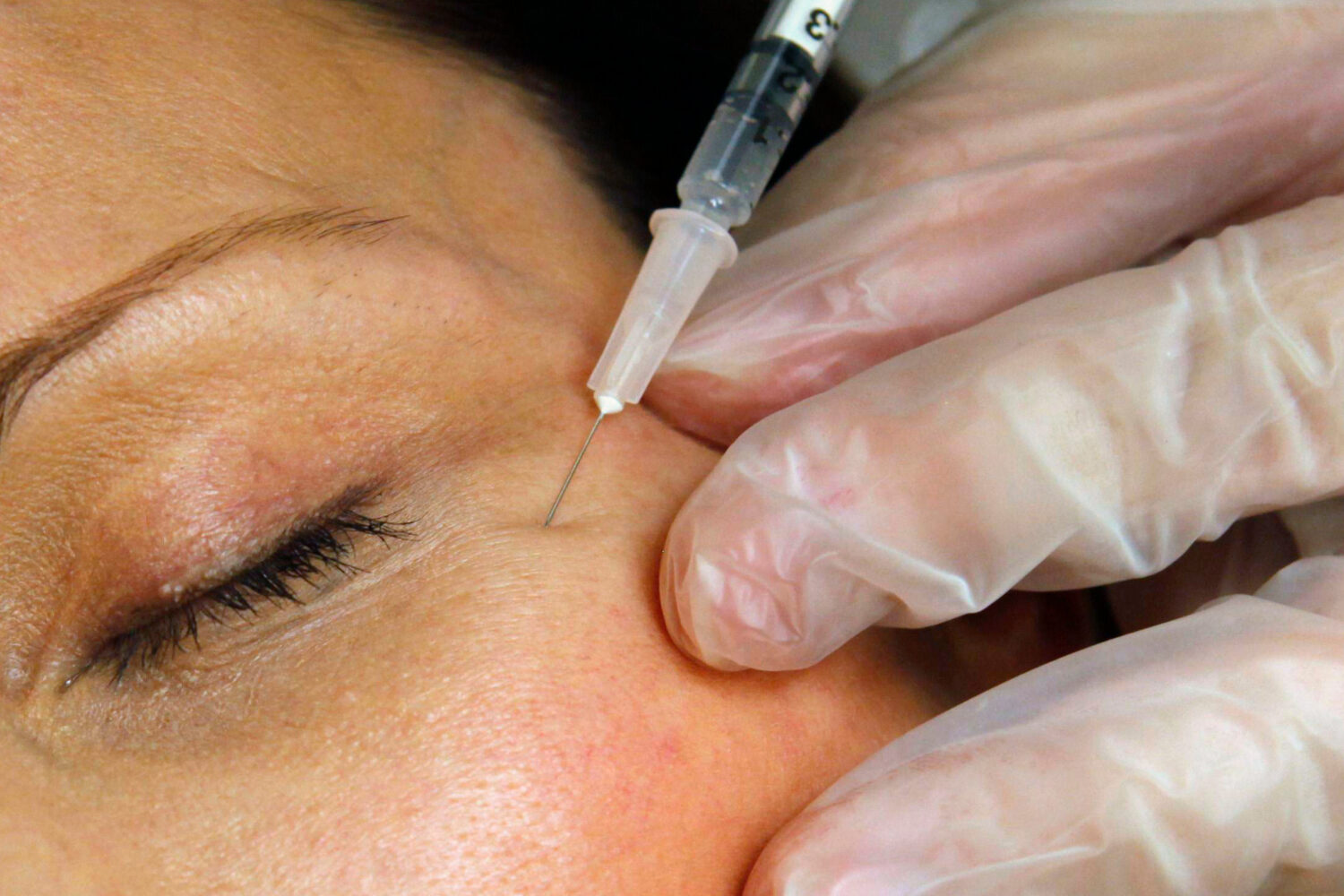 FILE - A patient receives a Botox injection at a clinic in Arlington, Va., on June 5, 2009. (AP Pho...